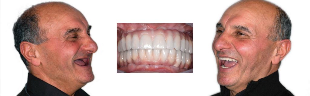 Implantologia dentale a Montagnana | Clinica dentale Mantoan