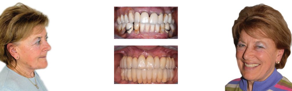 Impianti dentali | Implantologia dentale a Montagnana | Clinica dentale Mantoan