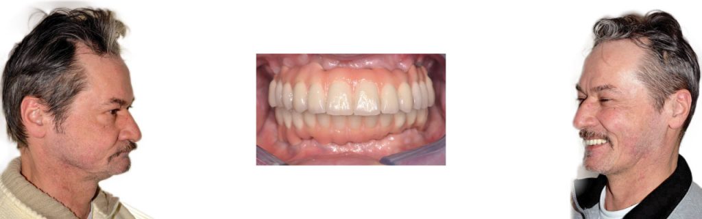 Impianto dentale | Implantologia dentale a Montagnana | Clinica dentale Mantoan