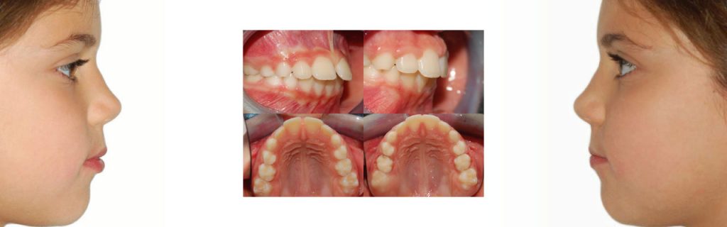 Apparecchio denti | Ortodonzia bambini | Clinica Dentale Mantoan