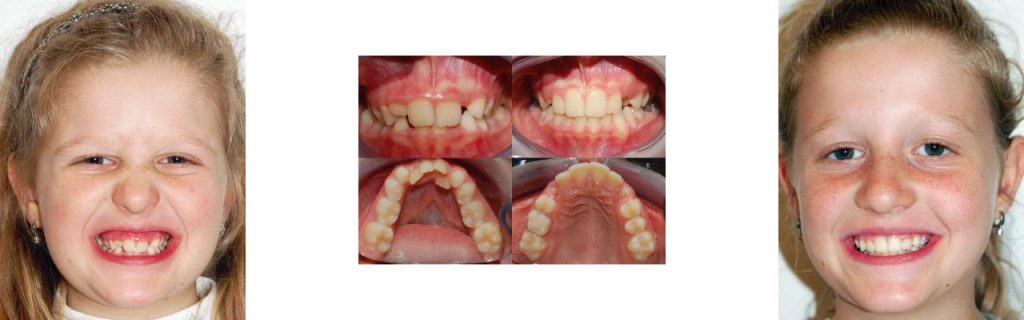 Ortodonzia per ragazzi a Montagnana | Clinica Dentale Mantoan