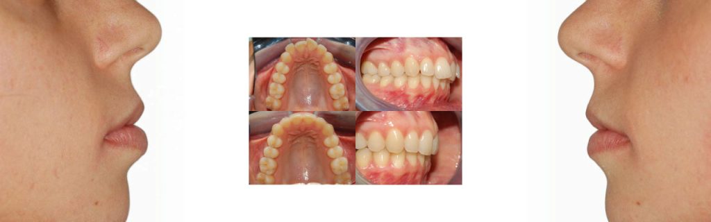 Apparecchio dentale | Ortodonzia ragazzi a Montagnana | Clinica dentale Mantoan