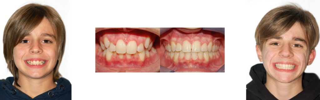 Apparecchio fisso | Ortodonzia ragazzi a Montagnana | Clinica dentale Mantoan