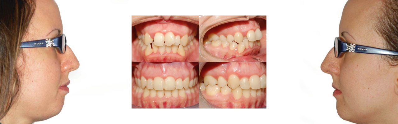 Apparecchio invisibile| Ortodonzia a Montagnana | Clinica dentale Mantoan