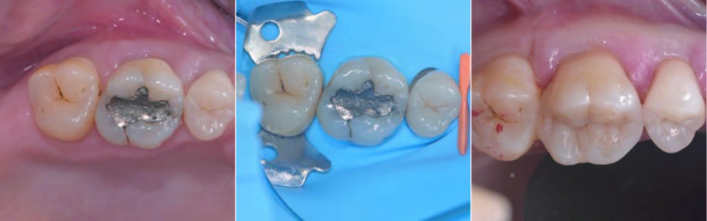 Otturazione | Odontoiatria Conservativa a Montagnana | Clinica Dentale Mantoan Otturazione | Odontoiatria Conservativa a Montagnana | Clinica Dentale Mantoan