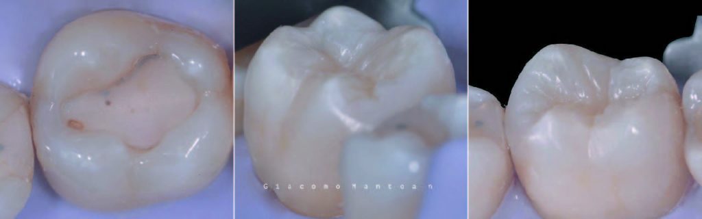 Carie denti | Odontoiatria Conservativa a Montagnana | Clinica Dentale Mantoan Carie denti | Odontoiatria Conservativa a Montagnana | Clinica Dentale Mantoan