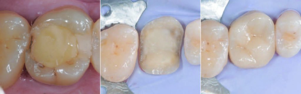 Otturazione | Odontoiatria Conservativa a Montagnana | Clinica Dentale Mantoan Otturazione | Odontoiatria Conservativa a Montagnana | Clinica Dentale Mantoan