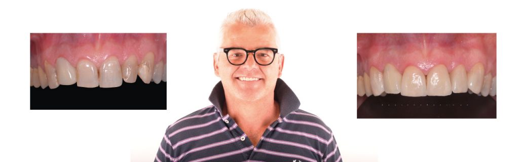 Faccette dentali | Odontoiatria estetica a Montagnana | Clinica Dentale Mantoan